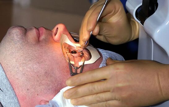 Scleroplastie voor bijziendheid om het gezichtsvermogen te stabiliseren