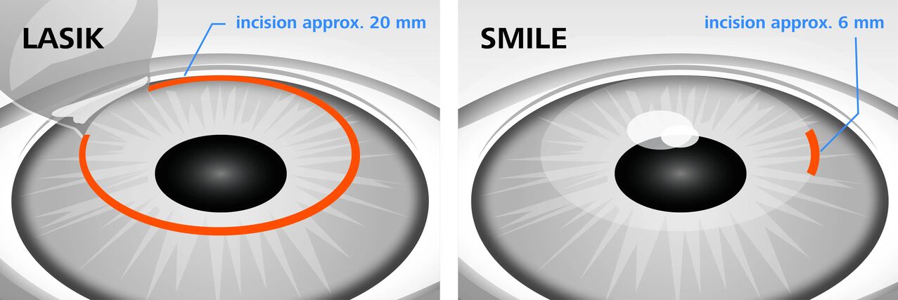 Vergelijking van laserzichtcorrectiemethoden LASIK en SMILE